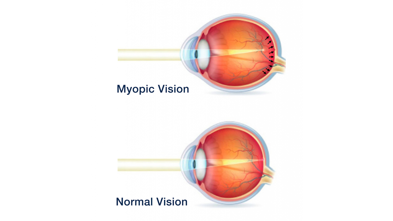 myopic eye vs normal eye